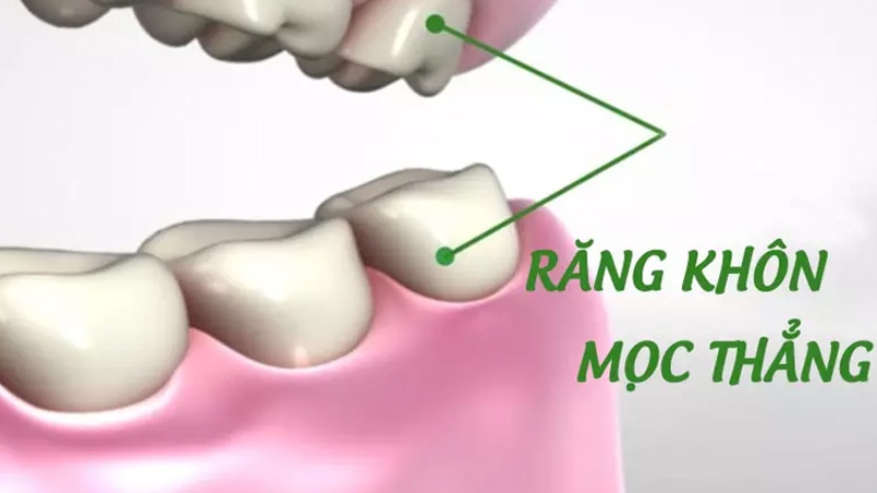 Trường hợp không nên nhổ răng khôn